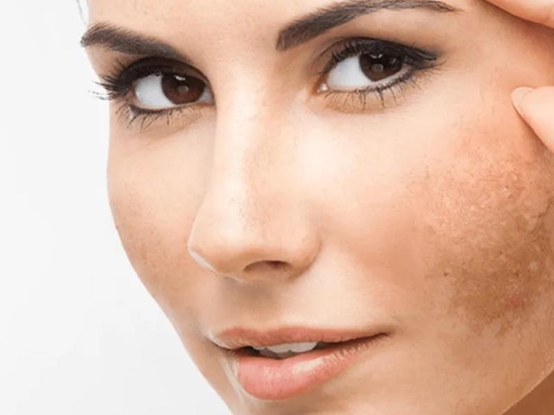 Melasma: o que é e como tratar do jeito certo
