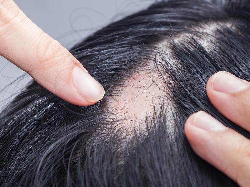 Tratamento para Alopecia