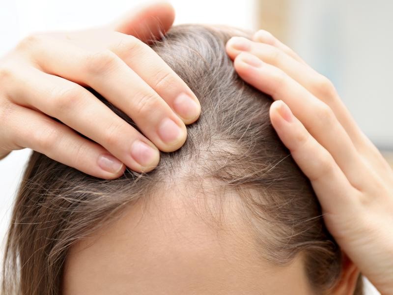 Tratamento para Calvície Feminina